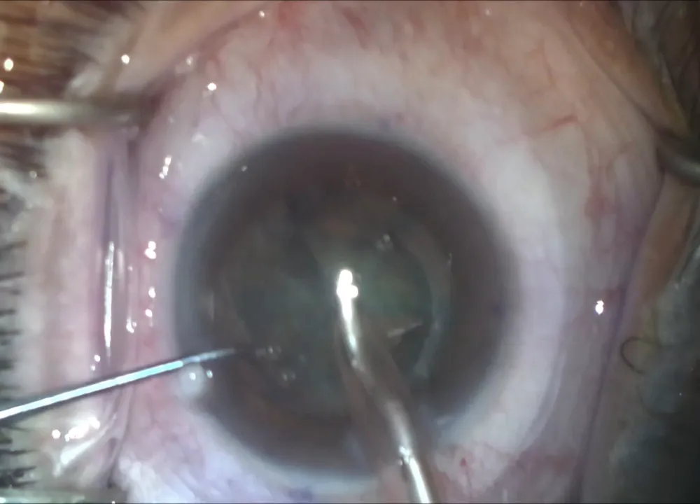 Softened cataract being removed